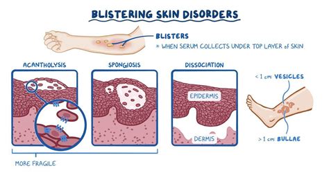 Blistering Skin Disorders Clinical Practice Osmosis
