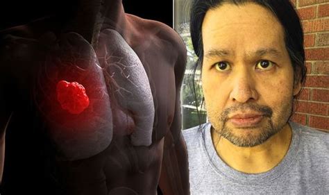 Lung Cancer Symptoms Signs Of Tumour Include Yellow Skin Or Eyes