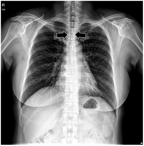 Preoperative Chest X Ray Shows Tracheal Stenosis Download Scientific