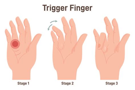 What Is Trigger Finger Causes Symptoms And Treatments