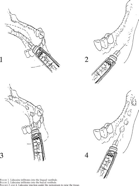 Figure 1 From Inferior Alveolar Nerve Block Anesthesia When Placing