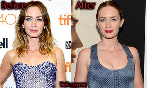 Emily Blunt Plastic Surgery Before And After Botox Pictures