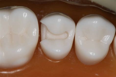 Class Ii Composite Dental Preparation Video
