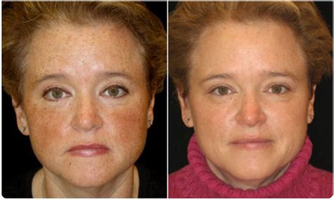 Photofacial Southern Cosmetic Laser Charleston Botox Massage