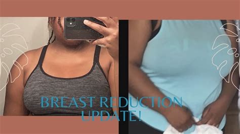 How I Lost 10 Pounds In 1 Day—breast Reduction Story Youtube