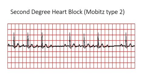Second Degree Heart Block Mobitz Type 2 Youtube