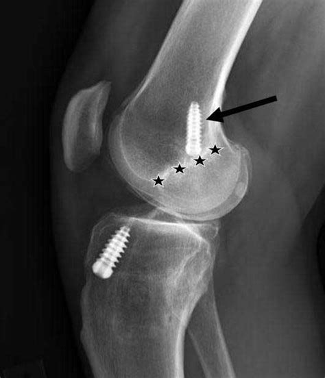 Acl Reconstruction Anterior Cruciate Ligament Surgery Knee