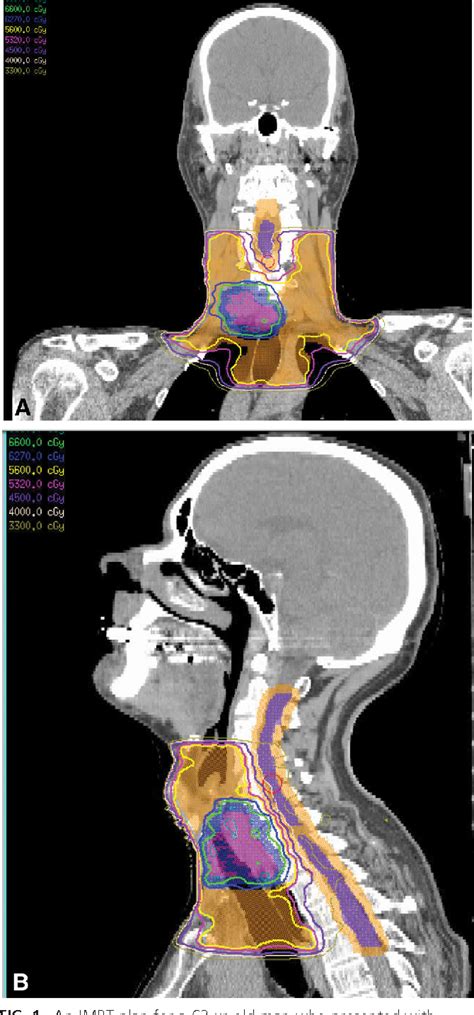 Papillary thyroid cancer, also referred as papillary thyroid carcinoma, is a common type of thyroid cancer. External Radiation Therapy Papillary Thyroid Cancer - All ...