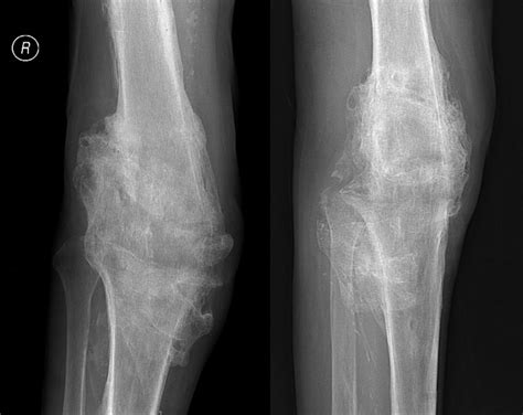 Radiographs With Evidence Of Knee Fusion 8 Months After The