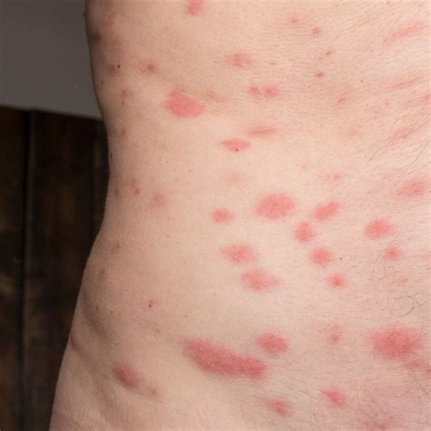 Bed Bug Bites Pictures On Legs