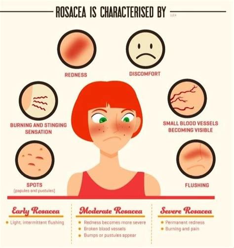 Rosacea Natural Remedies For Rosacea Rosacea Rosacea Skin Care