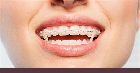 Data on file at align technology, as of september 9, 2020. How Long to Wear Rubber Bands For Braces | Chatham ...