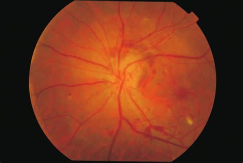 Presence Of Hyperaemic And Swollen Optic Disc With Pre Retinal
