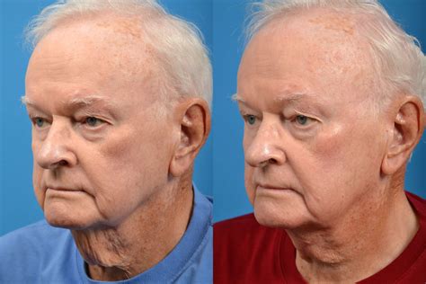 patient 122406260 male neck lift before and after photos clevens face and body specialists