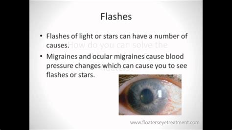 Eye Floaters Treatment And Flashes Of Light In Eye Youtube