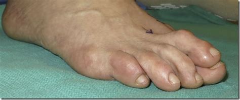 Large Bunion With Overlapping Toe Best Podiatrist NYC
