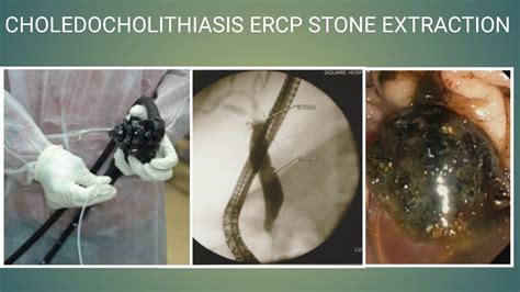 Choledocholithiasis Ercp Stone Extraction At Square Hospital Ltd Dhaka