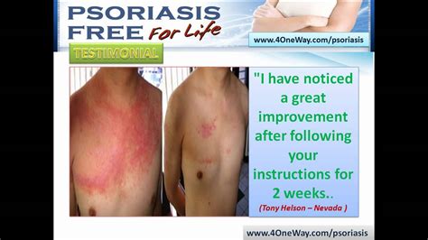 Psoriasis Holistic Treatment Natural Cure Psoriasis Youtube