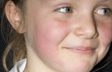 Slapped Cheek Syndrome Pictures Symptoms Treatment Causes