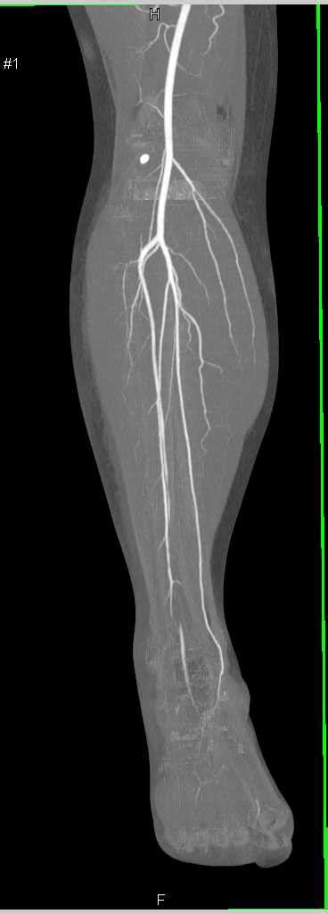 Ultrasound Image Of Distal Anterior Tibial Artery Realtec My XXX Hot Girl