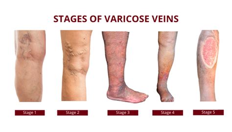 What Are Varicose Veins Symptoms Causes And Treatment Procedures