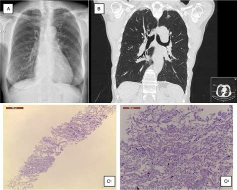 Espessamento Pleural Apical Bilateral