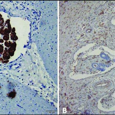 Histology Of Rectal Adenocarcinoma In Dogs A The Rectal Mucosa