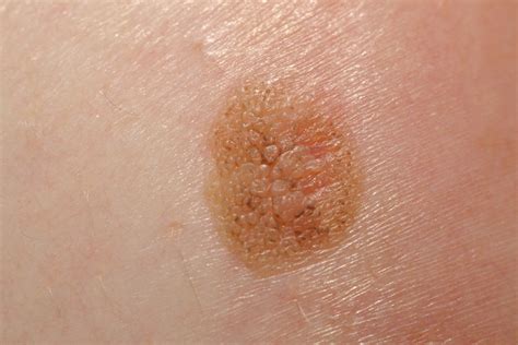 The ‘abcde Test To Identify The Most Dangerous Form Of Skin Cancer