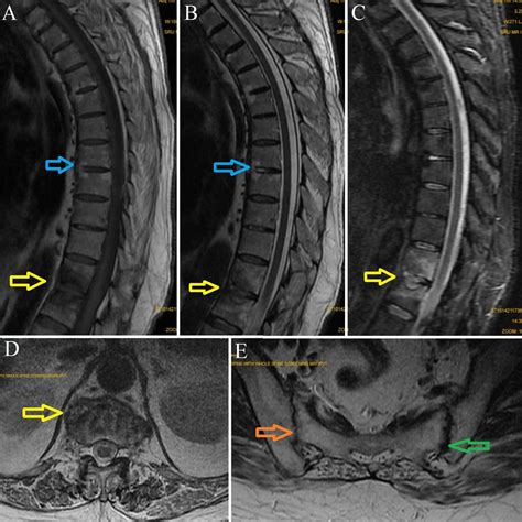 Andersson Lesion In Ankylosing Spondylitis Bmj Case Reports