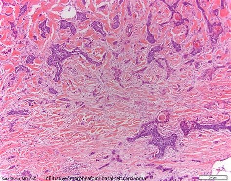 Pathology Outlines Basal Cell Carcinoma Bcc