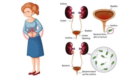Tips To Prevent Urinary Tract Infection Causes Symptoms Medintu