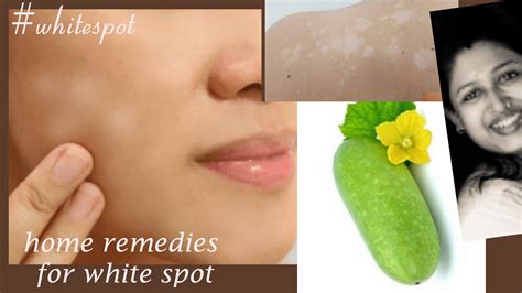 White Spot On Skin Home Treatment White Spot On Facewhite Spot In