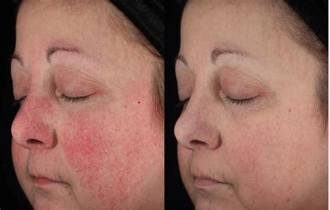 Laser Treatment For Rosacea Efficacy Before And Afters Cost And More