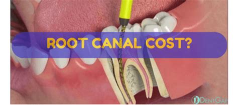 A successful root canal treatment may cause mild pain and sensitivity for a few days once the local anesthetic has worn. Root Canal Cost: Ways to Get Discount up to 50%