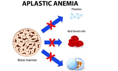 14 Causes Of Low Lymphocyte Countlymphocytopenia
