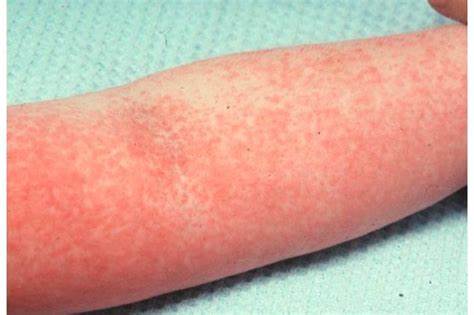 Дерматит симптомы диета Солнечный дерматит: причины, симптомы, диагностика и лечение Солнечный дерматит: причины, симптомы, диагностика и лечение Дерматит симптомы диета