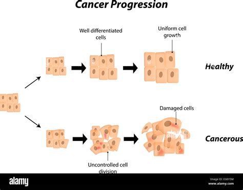 Cancer Progression Stock Vector Image And Art Alamy