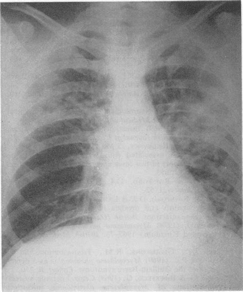 Chest X Ray Showing Bilateral Patchy Consolidation Download