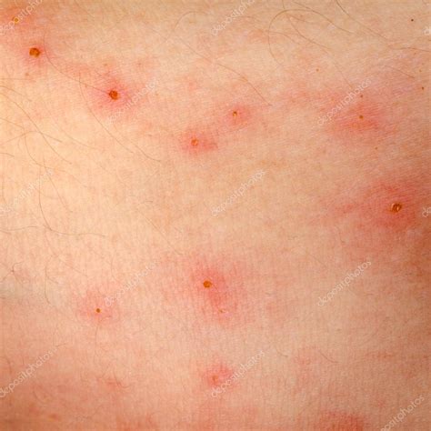 Allergic Rash Dermatitis Eczema Skin — Stock Photo © Panxunbin 17995667
