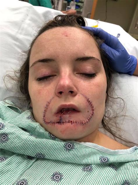 Woman Whose Ex Bit Off Her Lip Shares Emotional Facebook Post After