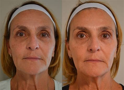 Bbl Photofacial Before After Photos Fresh Face Eye