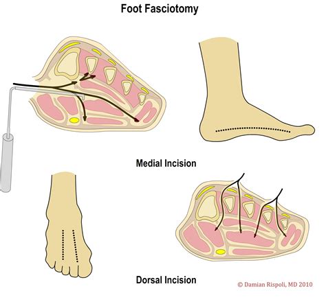 4 Fasciotomy Wheeless Textbook Of Orthopaedics