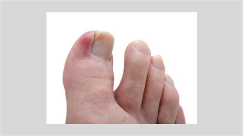 My toes hurt under the nail whenever there is pressure. Ingrown Toenails: Causes, Symptoms, and Diagnosis