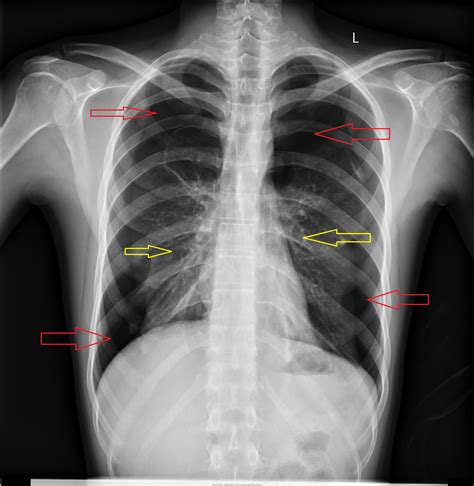Chest Radiograph Revealing The Presence Of Bilateral Pneumothorax And