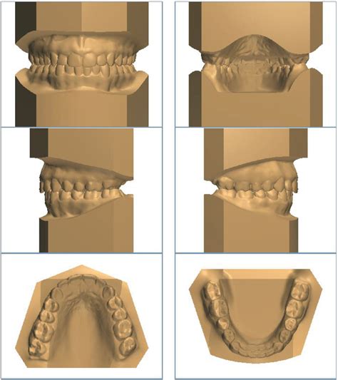Study Models Excel Orthodontics