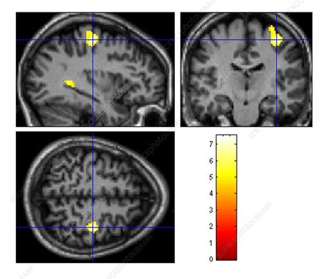 Motor Area Brain Activation Mri Scans Stock Image C0018155