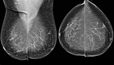 Comprehensive Review Of Breast Imaging Ubicaciondepersonascdmxgobmx