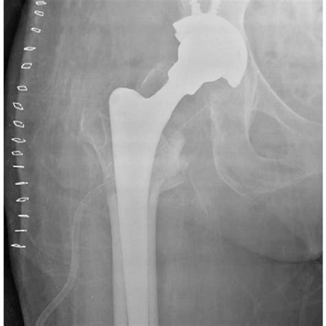 Pdf A Rare Complication After Intertrochanteric Fracture Treated With