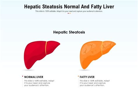 Hepatic Steatosis Normal And Fatty Liver Presentation Graphics