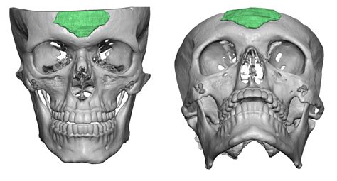 Plastic Surgery Case Study Glabellar Forehead Augmentation With Bone